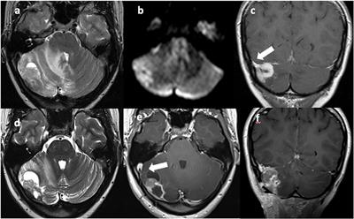 Case Report: Remarkable breakthrough: successful treatment of a rare intracranial mesenchymal, FET::CREB fusion-positive tumor treated with patient-tailored multimodal therapy